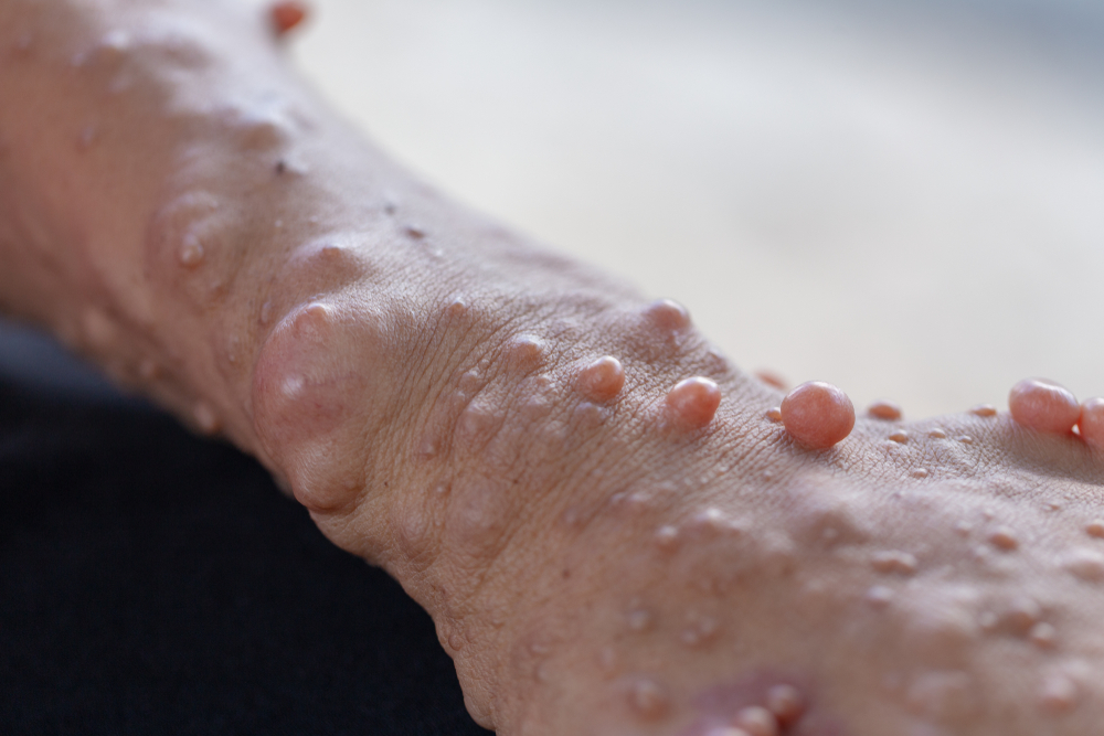 Neurofibromatosis: Managing Symptoms and Effective Treatments