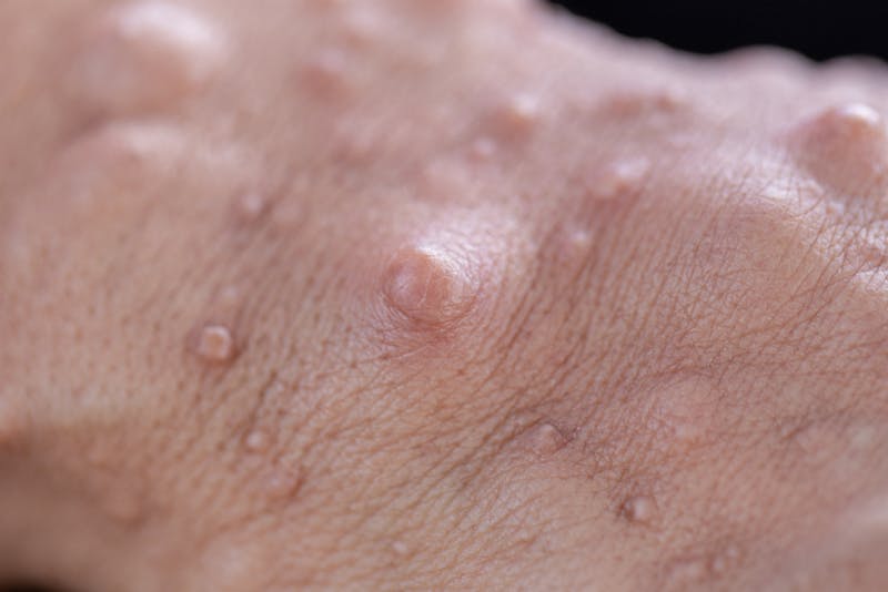 The Role of ICD-10 in Neurofibromatosis Management | Pasadena, CA
