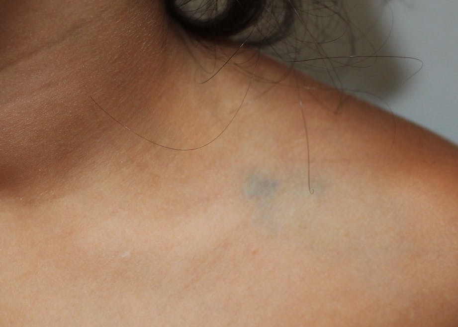 Dr. Panossian tailors advanced therapies for venous malformations, optimizing outcomes and minimizing long-term risks