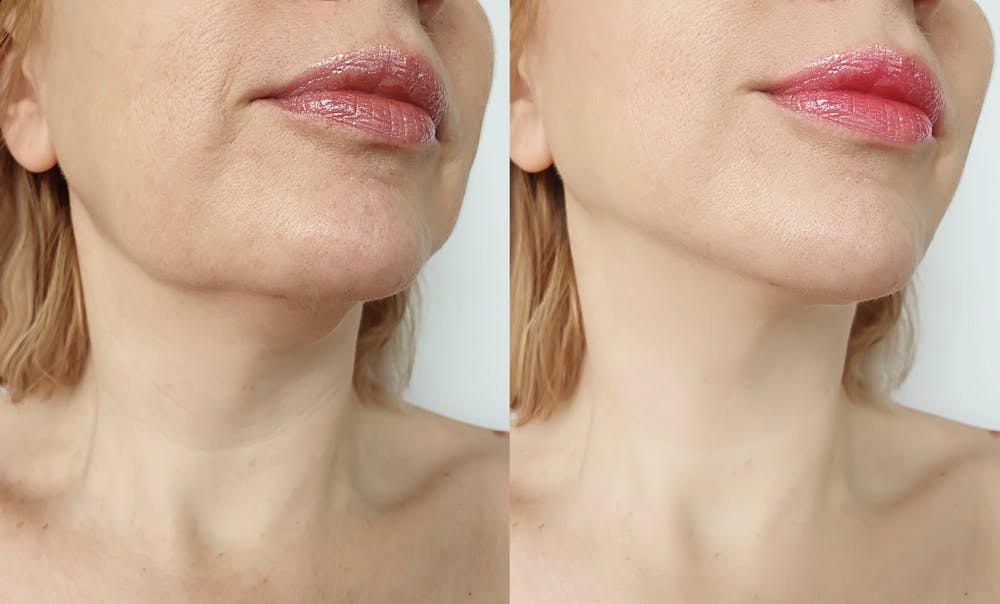 Noticing post-mini facelift changes? Sagging, renewed wrinkles, or imbalance may signal a need for revision surgery.