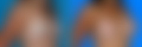 ,  Before and After Photos Breast Augmentation Before and After Photos in Pasadena, CA, patient 19033