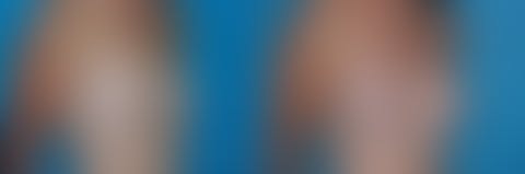 ,  Before and After Photos Breast Augmentation Before and After Photos in Pasadena, CA, patient 19018