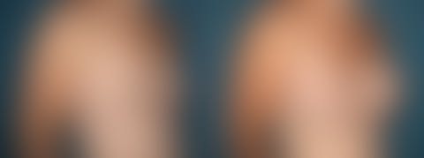 ,  Before and After Photos Breast Augmentation Before and After Photos in Pasadena, CA, patient 18876