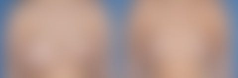 Breast Lift/Reduction Before and After Photos in Pasadena, CA, patient 17542