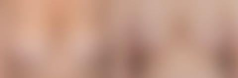 ,  Before and After Photos Breast Lift/Reduction Before and After Photos in Pasadena, CA, patient 10103