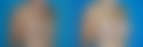 ,  Before and After Photos Breast Augmentation Before and After Photos in Pasadena, CA, patient 18946