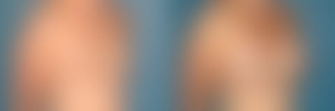 ,  Before and After Photos Breast Augmentation Before and After Photos in Pasadena, CA, patient 18889