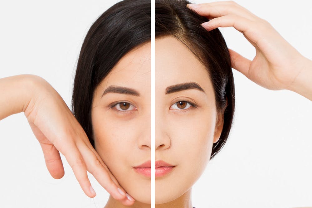 patient during recovery period after laser blepharoplasty