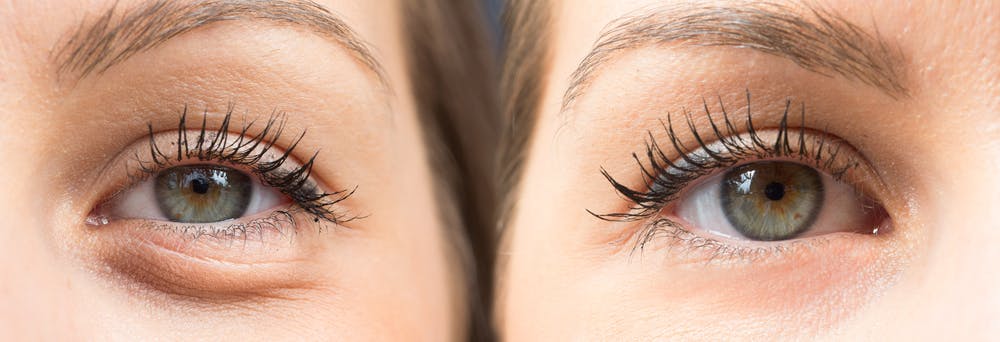 safety precautions in laser blepharoplasty procedure