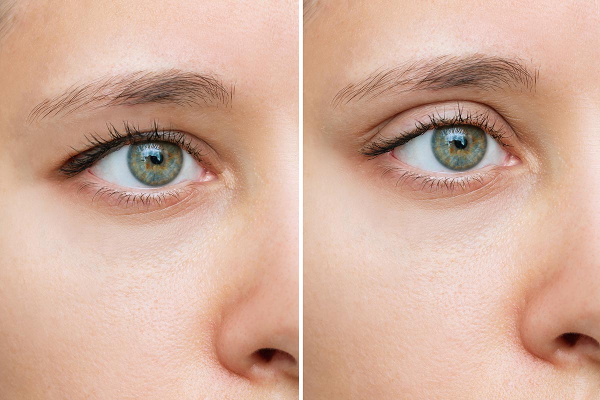 Hooded Eyes Makeover Explore Blepharoplasty for a Fresh Look