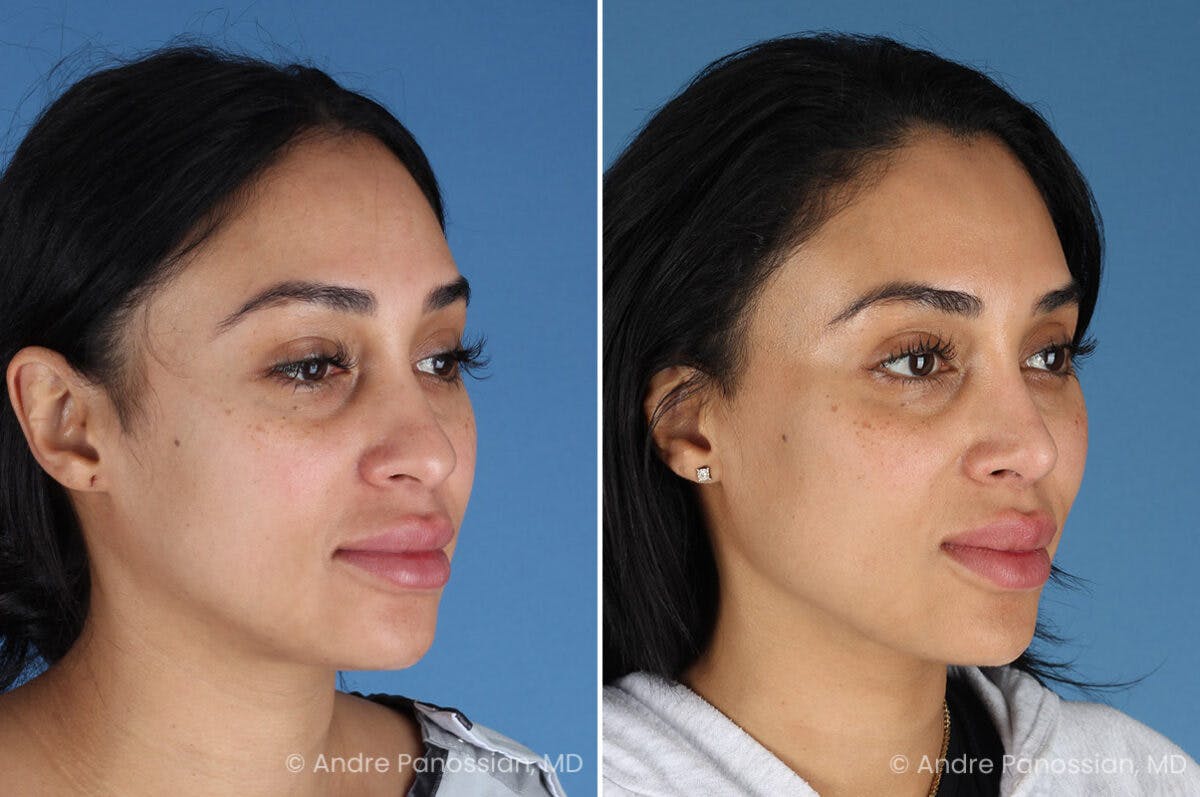 Rhinoplasty Before & After Gallery - Patient 156006 - Image 3
