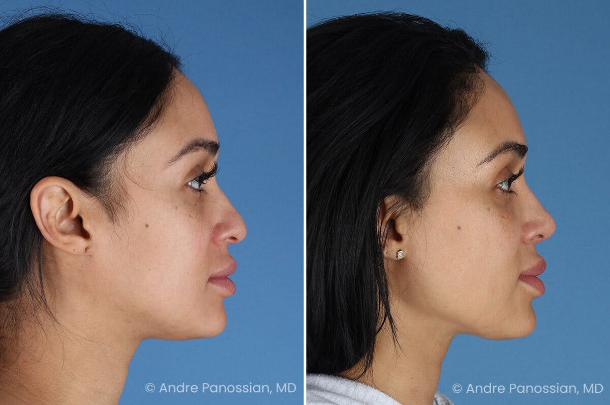 Rhinoplasty Before & After Gallery - Patient 156006 - Image 4