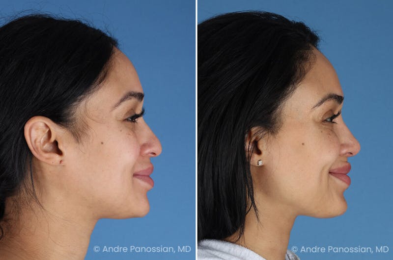 Rhinoplasty Before & After Gallery - Patient 156006 - Image 1
