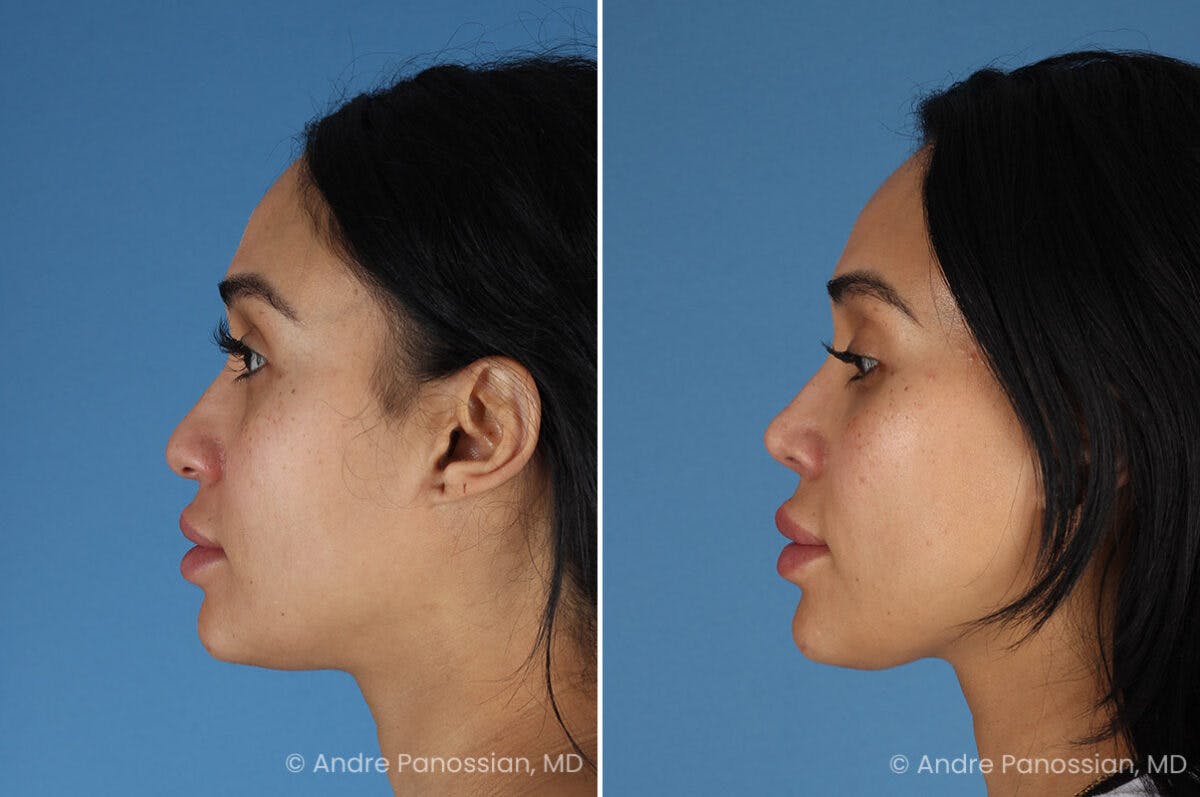 Rhinoplasty Before & After Gallery - Patient 156006 - Image 5