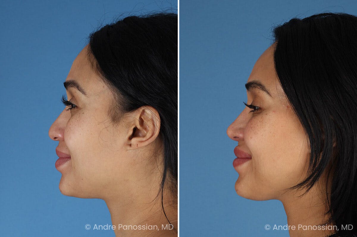 Rhinoplasty Before & After Gallery - Patient 156006 - Image 6