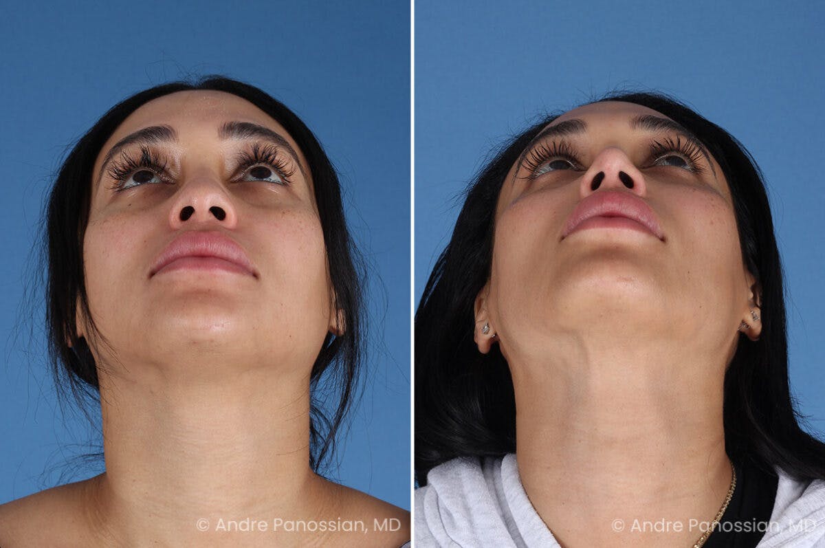 Rhinoplasty Before & After Gallery - Patient 156006 - Image 7