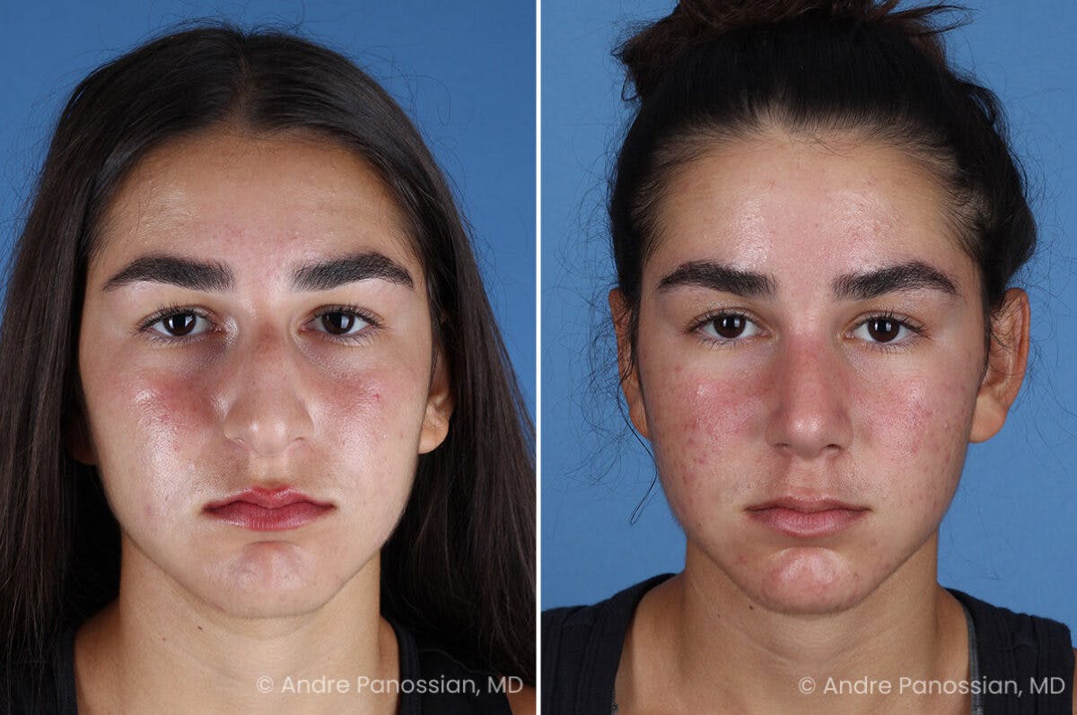 Rhinoplasty Before & After Gallery - Patient 127365 - Image 2