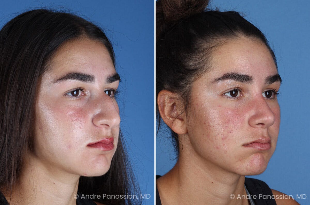 Rhinoplasty Before & After Gallery - Patient 127365 - Image 3