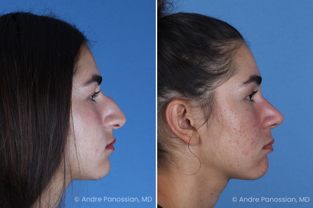 Rhinoplasty Before & After Gallery - Patient 127365 - Image 4