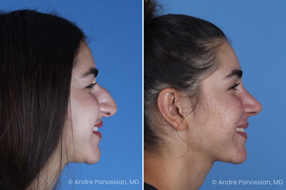 Rhinoplasty before and after — actual patient of Andre Panossian, MD