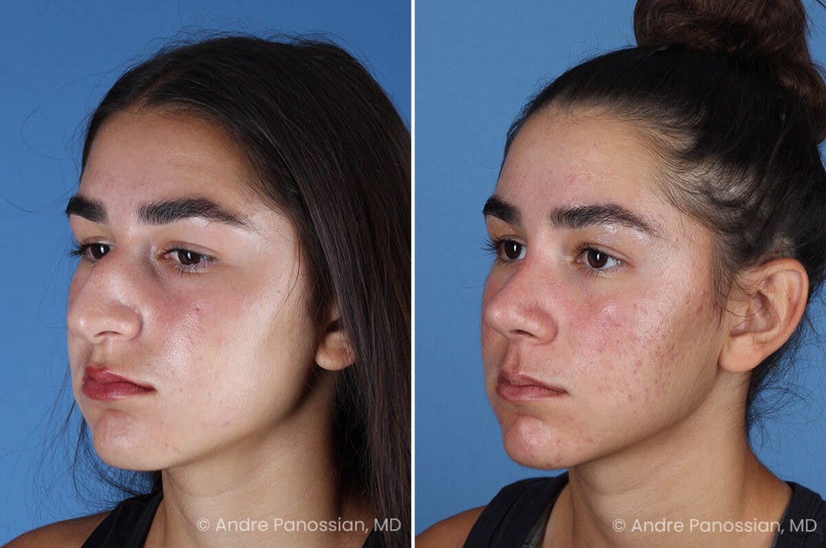 Rhinoplasty Before & After Gallery - Patient 127365 - Image 5