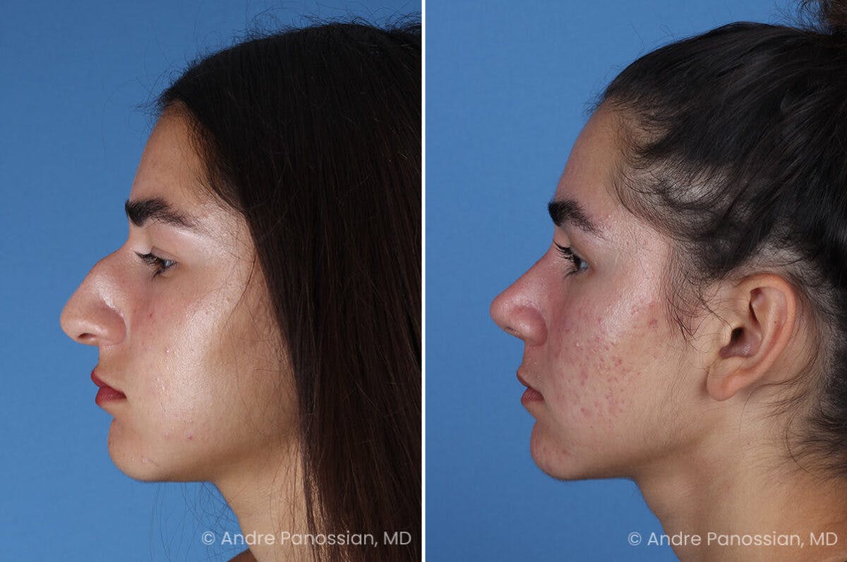 Rhinoplasty Before & After Gallery - Patient 127365 - Image 6