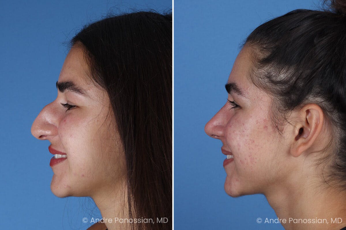 Rhinoplasty Before & After Gallery - Patient 127365 - Image 7