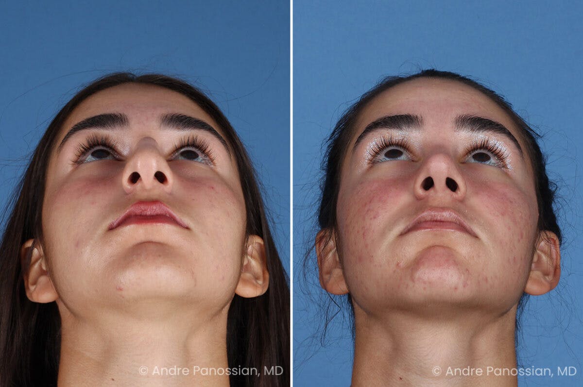 Rhinoplasty Before & After Gallery - Patient 127365 - Image 8