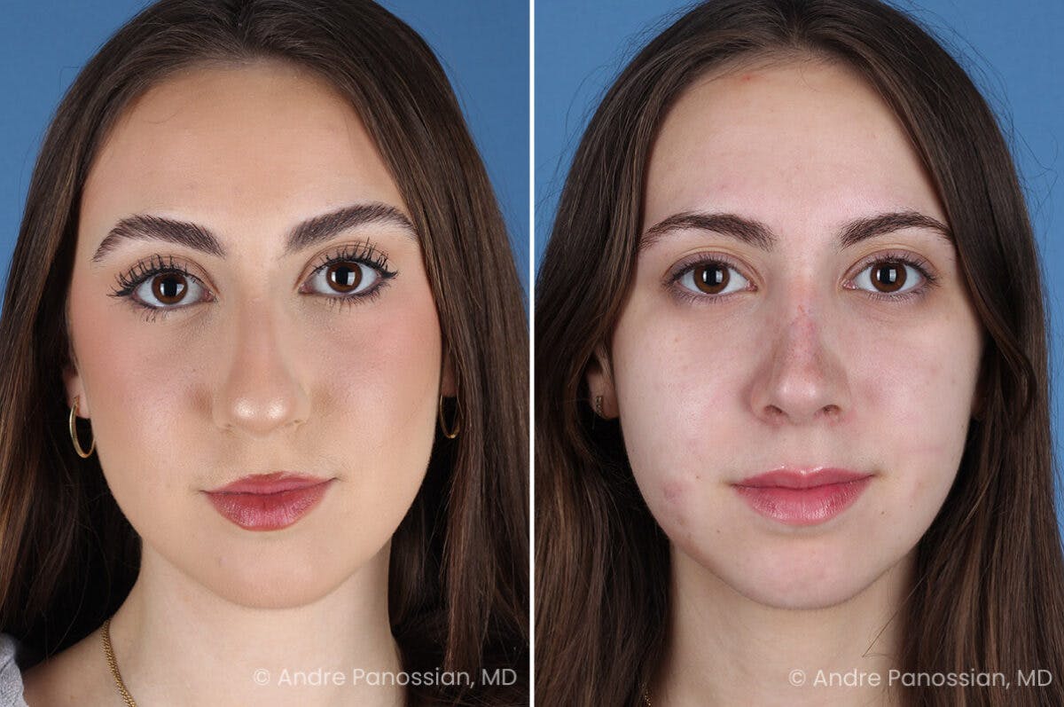 Rhinoplasty Before & After Gallery - Patient 308277 - Image 2