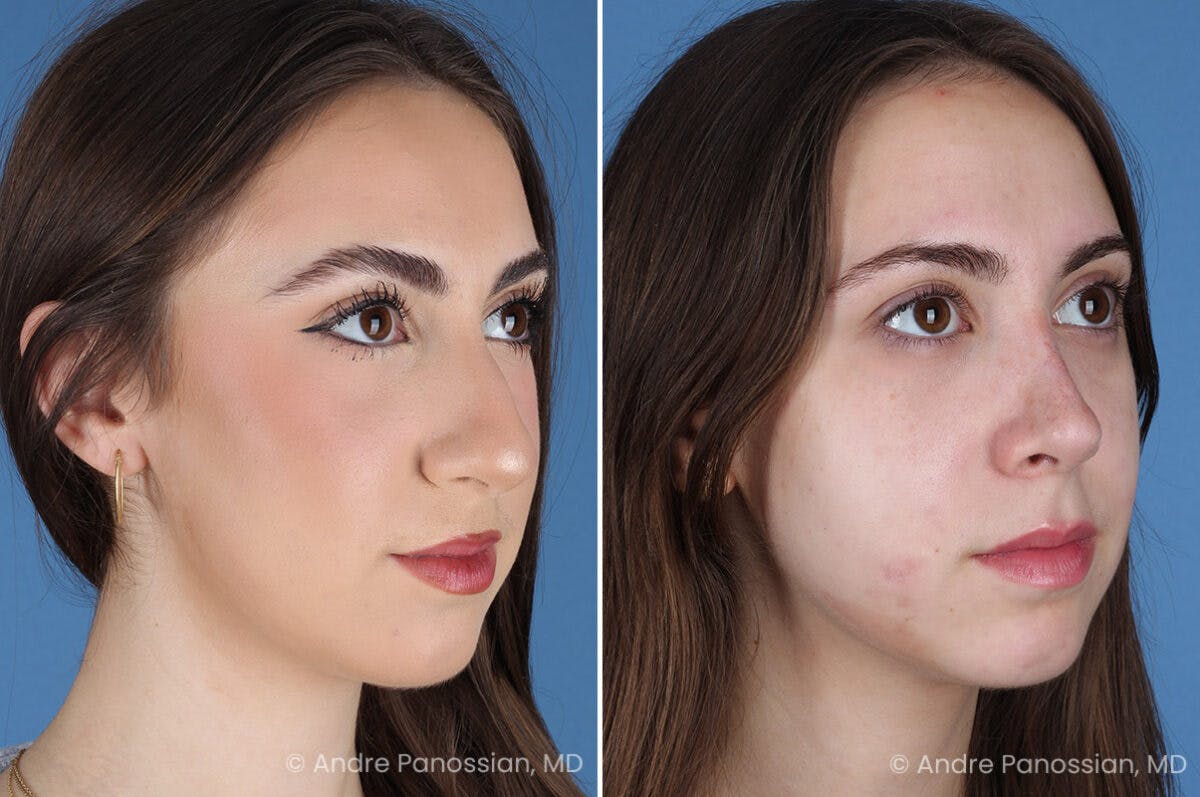 Rhinoplasty Before & After Gallery - Patient 308277 - Image 3