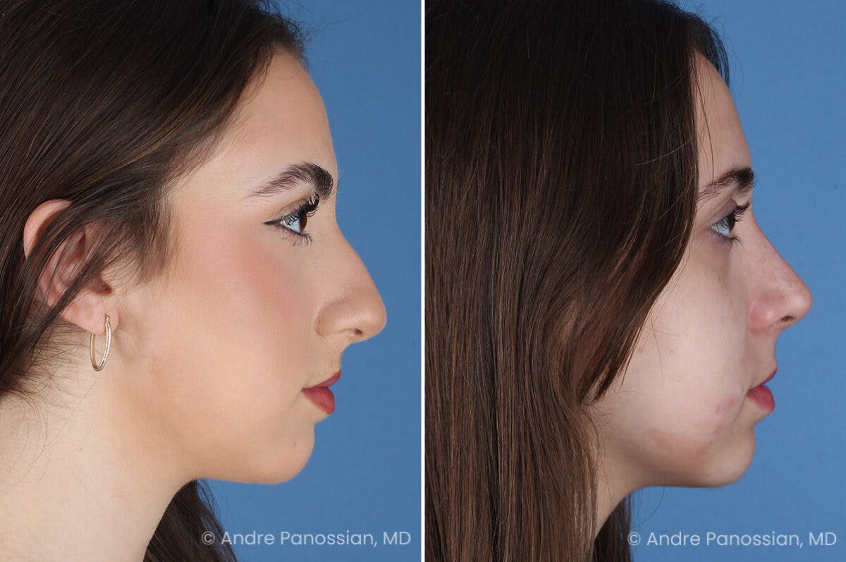 Rhinoplasty Before & After Gallery - Patient 308277 - Image 4