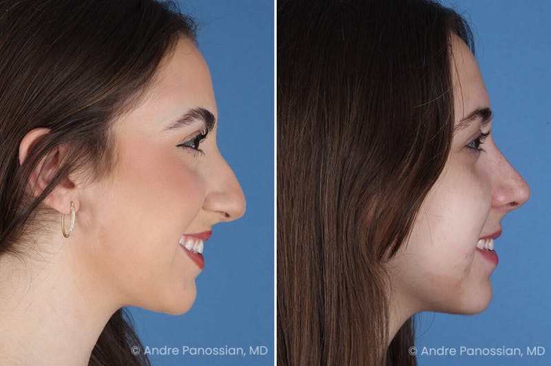 Rhinoplasty Before & After Gallery - Patient 308277 - Image 1