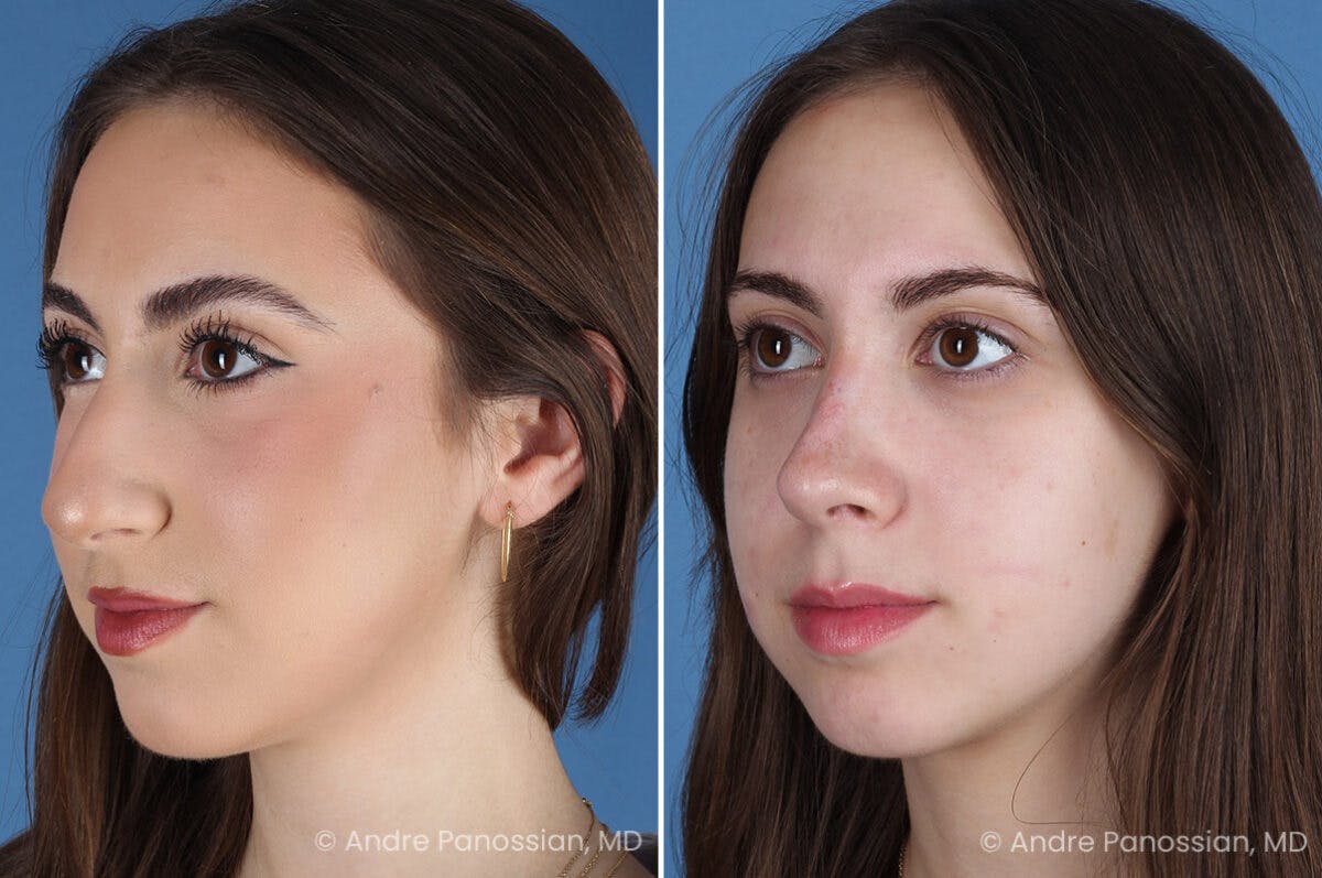 Rhinoplasty Before & After Gallery - Patient 308277 - Image 5