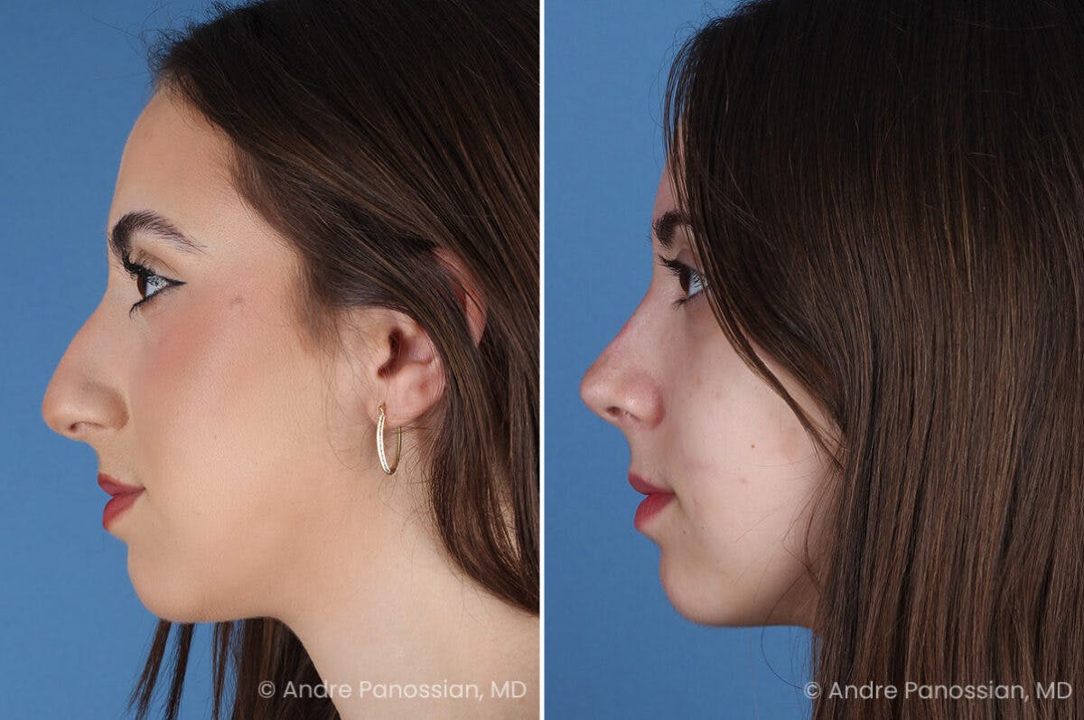 Rhinoplasty Before & After Gallery - Patient 308277 - Image 6
