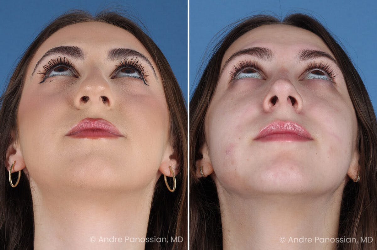 Rhinoplasty Before & After Gallery - Patient 308277 - Image 7