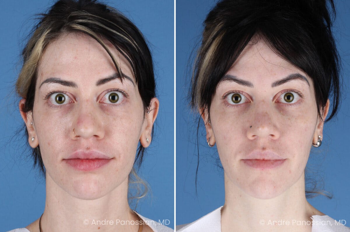 Rhinoplasty Before & After Gallery - Patient 366016 - Image 2