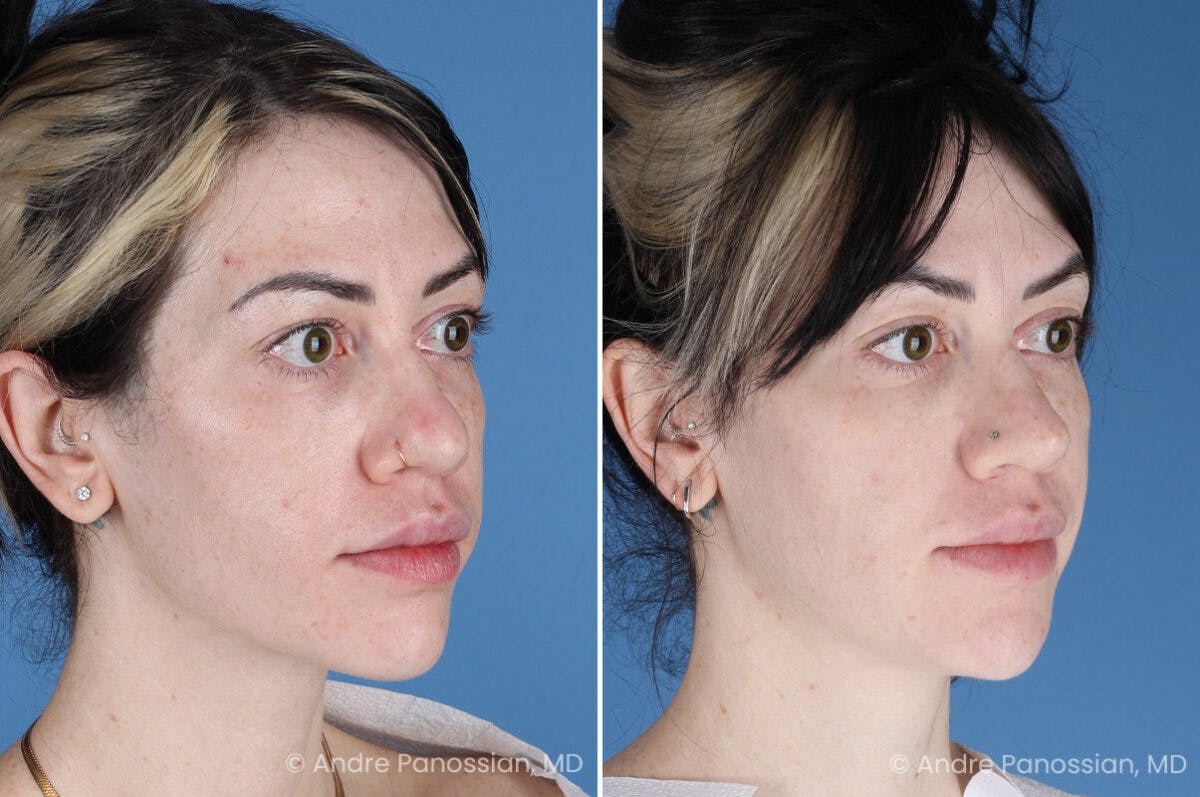 Rhinoplasty Before & After Gallery - Patient 366016 - Image 3