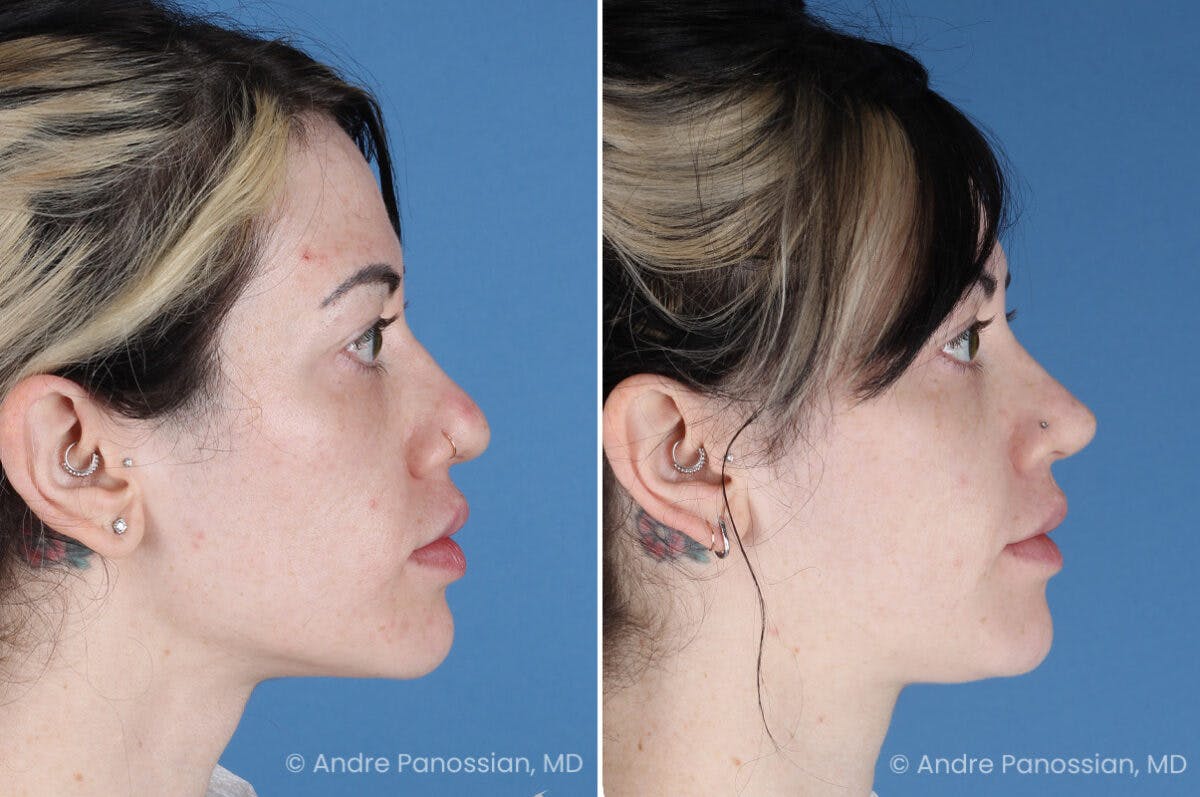 Rhinoplasty Before & After Gallery - Patient 366016 - Image 1