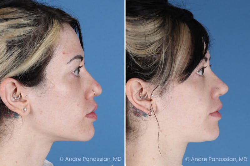 Rhinoplasty Before & After Gallery - Patient 366016 - Image 1