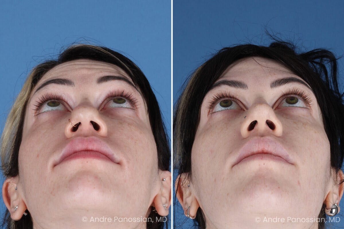 Rhinoplasty Before & After Gallery - Patient 366016 - Image 4