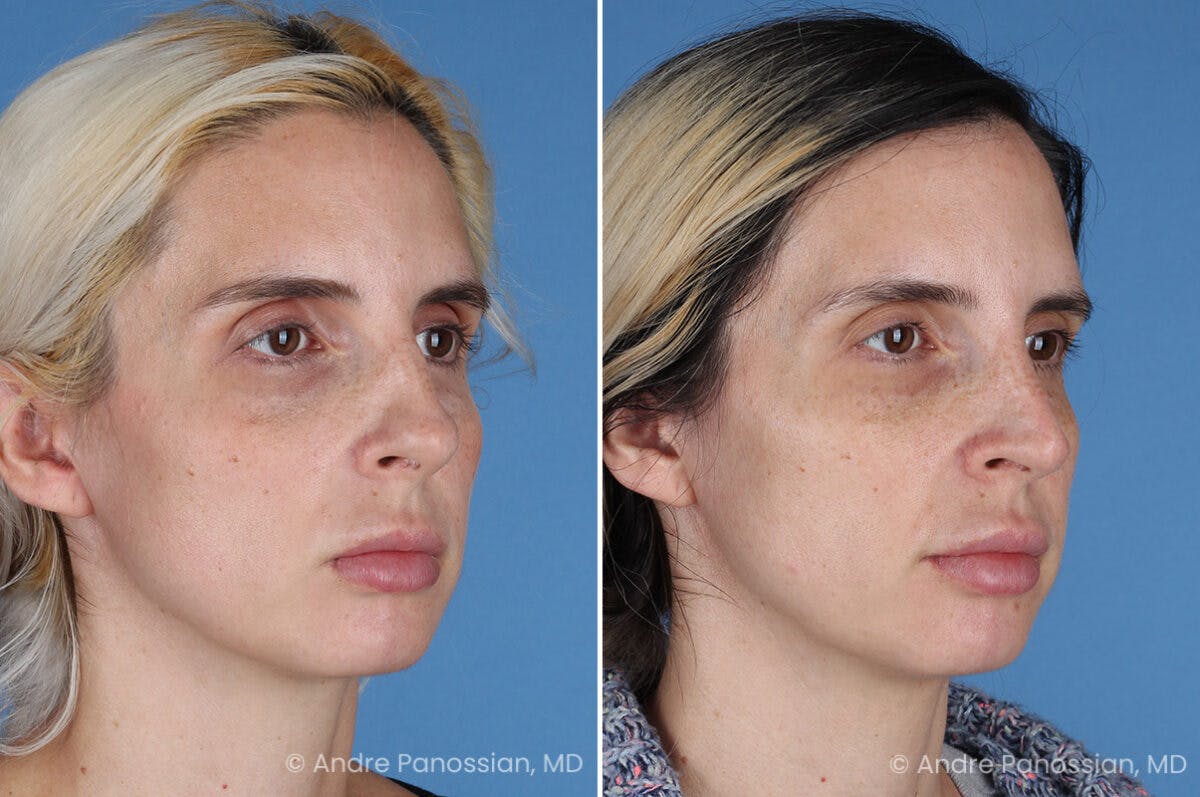Rhinoplasty Before & After Gallery - Patient 257691 - Image 3