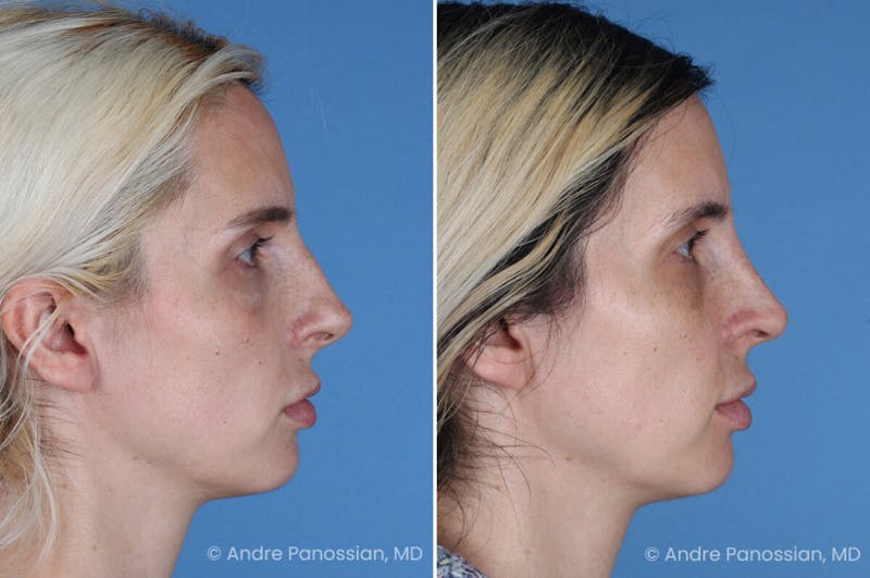 Rhinoplasty Before & After Gallery - Patient 257691 - Image 1