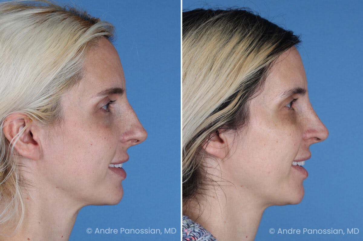 Rhinoplasty Before & After Gallery - Patient 257691 - Image 4