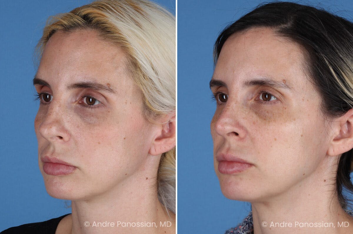 Rhinoplasty Before & After Gallery - Patient 257691 - Image 5