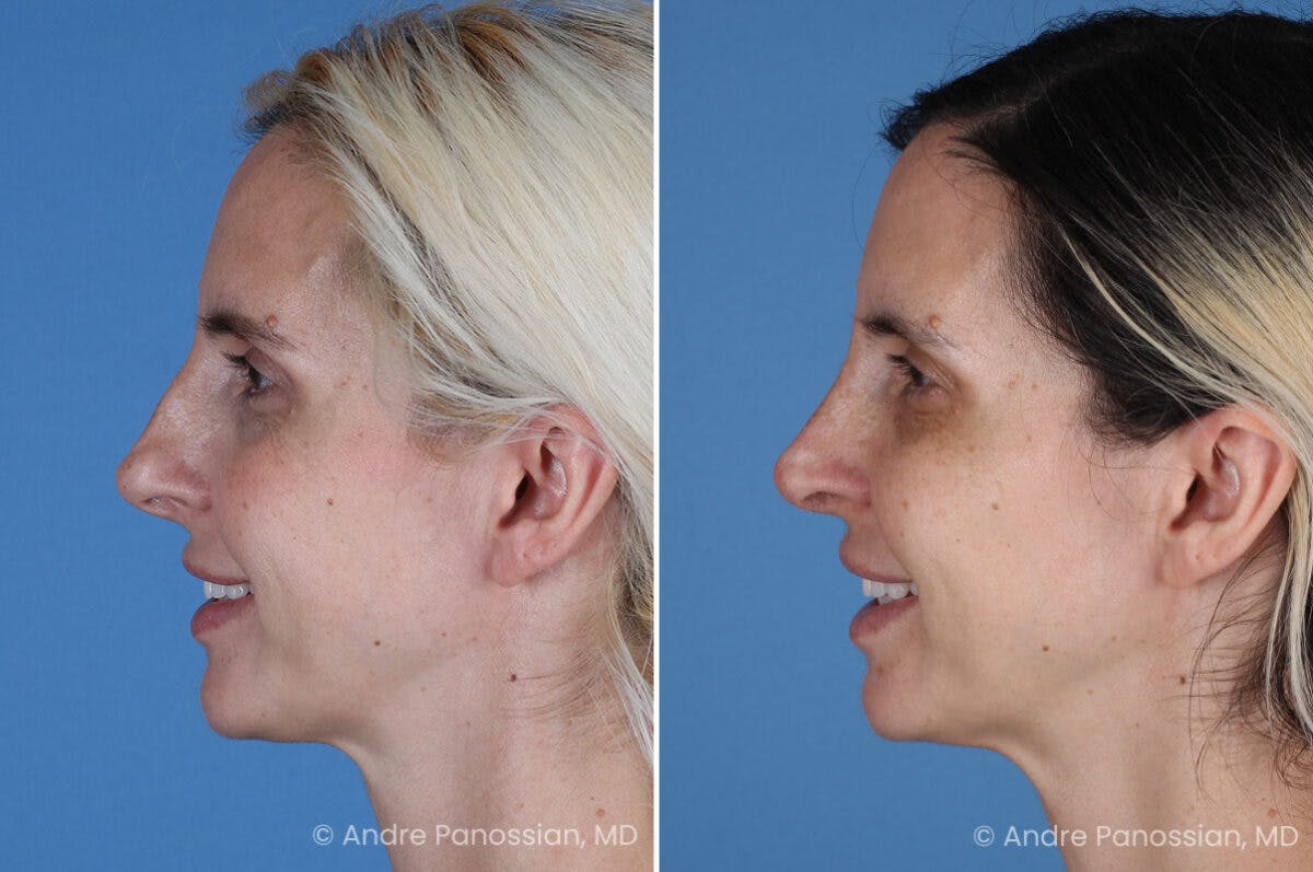 Rhinoplasty Before & After Gallery - Patient 257691 - Image 7