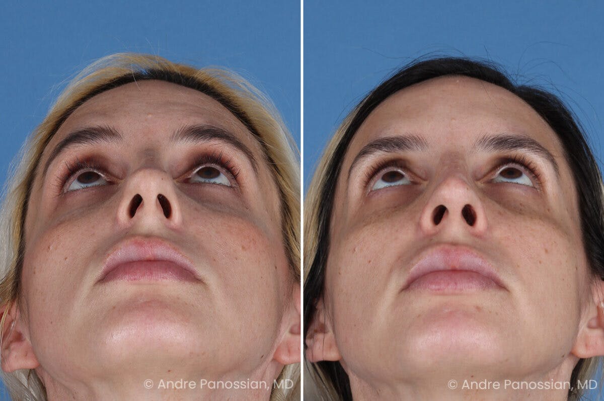 Rhinoplasty Before & After Gallery - Patient 257691 - Image 8