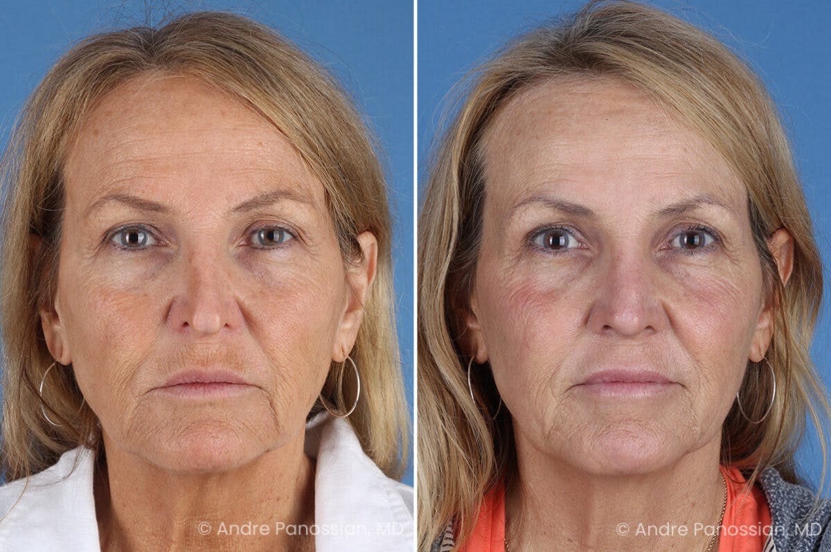 Revision Rhinoplasty Before & After Gallery - Patient 283123 - Image 2