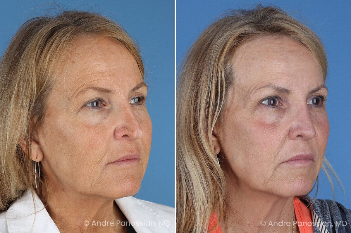 Revision Rhinoplasty Before & After Gallery - Patient 283123 - Image 3