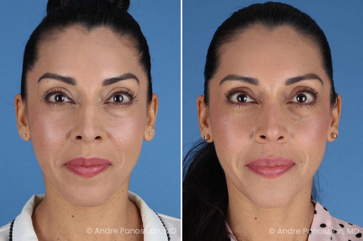 Rhinoplasty Before & After Gallery - Patient 364218 - Image 2