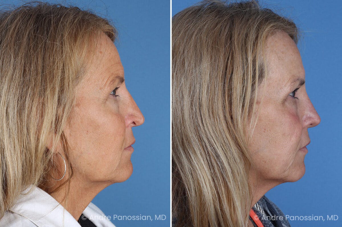 Revision Rhinoplasty Before & After Gallery - Patient 283123 - Image 4